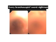 bronchoscopist’s procedure, Cryo-biopsies at our center, RHL, Jaipur