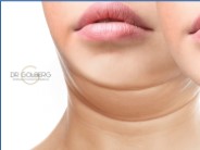 Non Surgical Nose Augmentation in NYC
