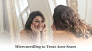 Microneedling To Treat Acne Scars