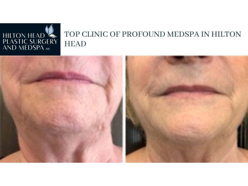 Top Clinic Of profound medspa In Hilton Head