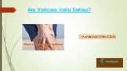 Are Varicose Veins Serious?