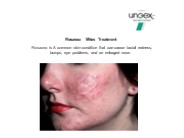 Rosacea Mites Treatment