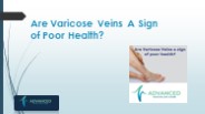 Are Varicose Veins A Sign Of Poor Health