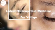 Latest Homeopathic Medicine For Vitiligo
