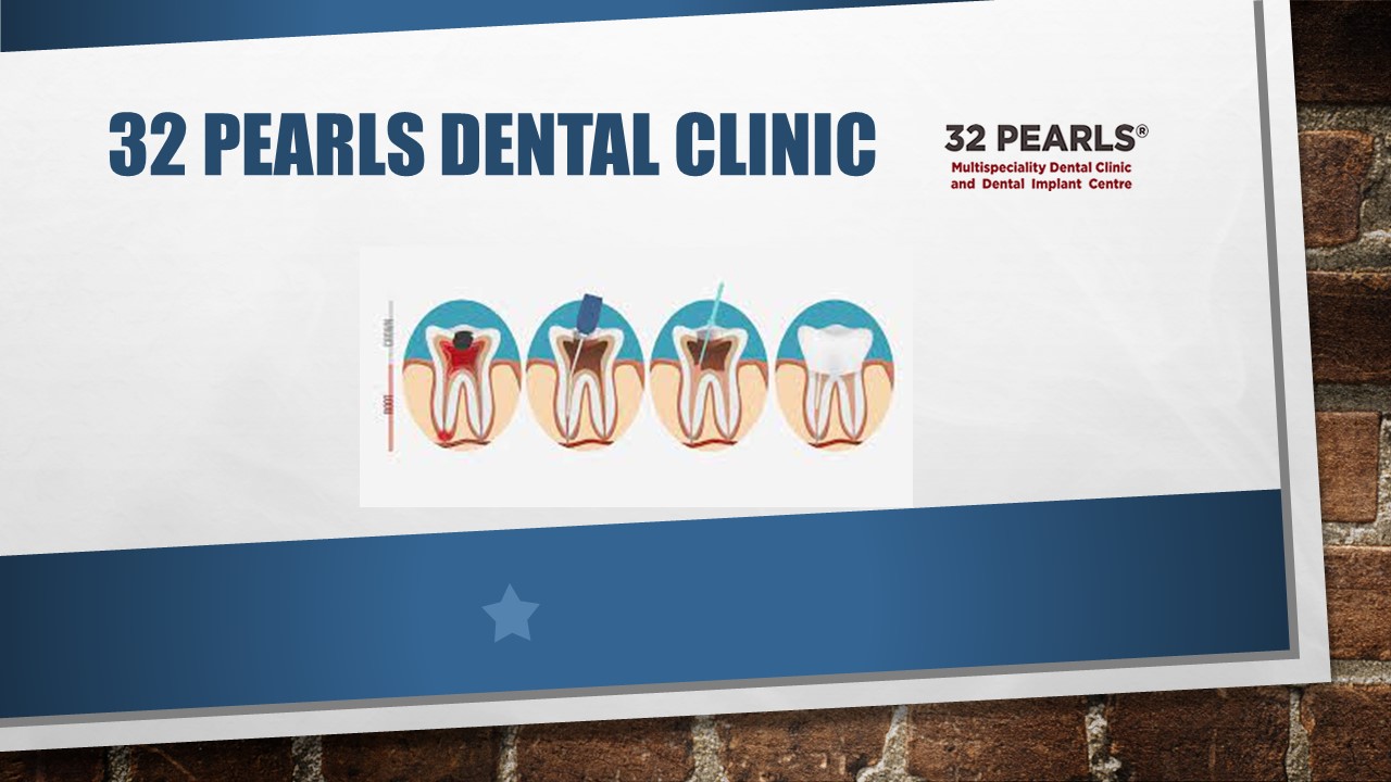 Root Canal Treatment in India