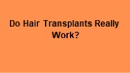 Does Hair Transplant really works?