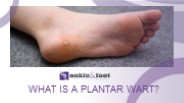 What is a Plantar Wart?