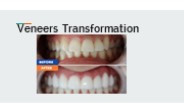 Veneers Transformation