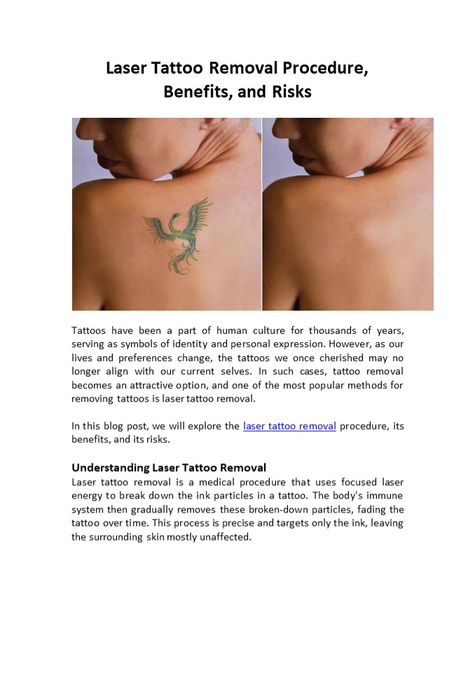Laser Tattoo Removal Procedure, Benefits, and Risks
