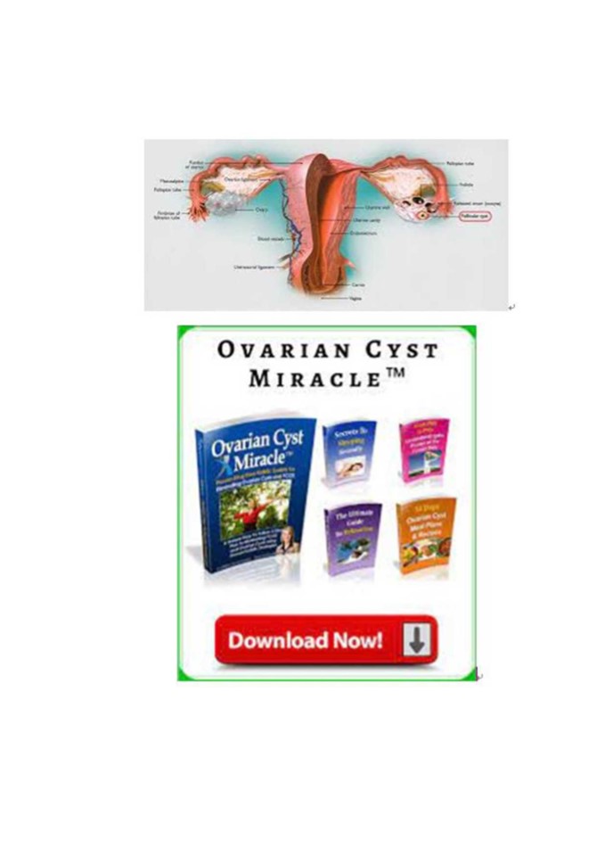 Ovarian Cyst Miracle PDF Manual & Guide eBook Download
