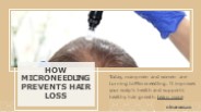 How Microneedling Prevents Hair Loss (1)