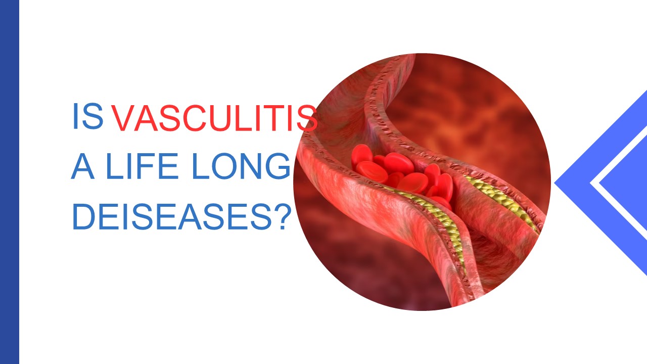 Is vasculitis a life long diseases ?