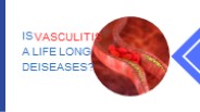 Is vasculitis a life long diseases ?