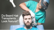 Do Beard Hair Transplants Look Natural?