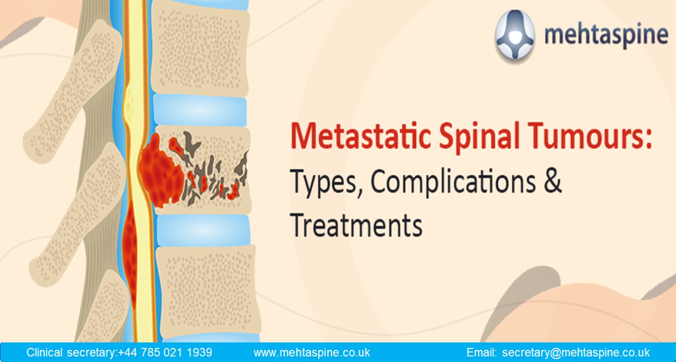 Metastatic Spinal Tumours:Types, Complications & Treatment