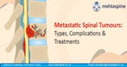 Metastatic Spinal Tumours:Types, Complications & Treatment