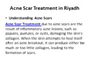 Acne Scar Treatment in Riyadh