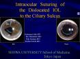Intraocular Suturing of the Dislocated IOL to the Ciliary Sulcus PowerPoint PPT Presentation