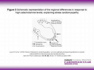Figure 3 Schematic representation of the regional differences in response to high catecholamine levels, explaining stress cardiomyopathy