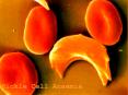 Sickle Cell Anaemia PowerPoint PPT Presentation