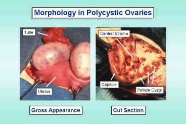 Abnormal Steroidogenesis and Related Disorders of Ovulation