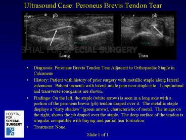 Ultrasound Case: Peroneus Brevis Tendon Tear
