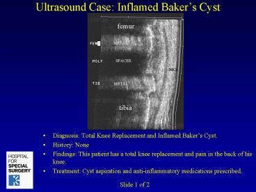 Ultrasound Case: Inflamed Bakers Cyst