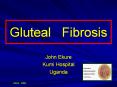 Gluteal  Fibrosis PowerPoint PPT Presentation