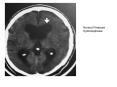 Normal Pressure Hydrocephalus PowerPoint PPT Presentation