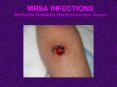 MRSA INFECTIONS MethicillinResistant Staphhylococcus Aureus PowerPoint PPT Presentation