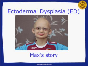Ectodermal Dysplasia ED