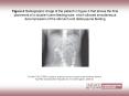 Figure 4 Radiographic image of the patient in Figure 3 that shows the final placement of a double-lumen feeding tube, which allowed simultaneous decompression of the stomach and distal jejunal feeding PowerPoint PPT Presentation