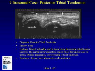 Ultrasound Case: Posterior Tibial Tendonitis
