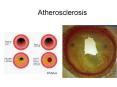 Atherosclerosis PowerPoint PPT Presentation