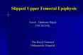 Slipped Upper Femoral Epiphysis PowerPoint PPT Presentation