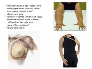 Mary Jane found a pea shaped lump