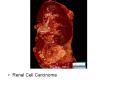 Renal Cell Carcinoma PowerPoint PPT Presentation