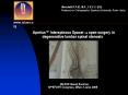 Aperius Interspinous Spacer vs open surgery in degenerative lumbar spinal stenosis ISLASS Guest Sess PowerPoint PPT Presentation