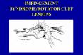 IMPINGEMENT SYNDROMEROTATOR CUFF LESIONS PowerPoint PPT Presentation