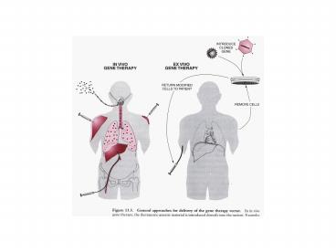 Gene Therapy for SCIDX1