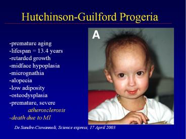 HutchinsonGuilford Progeria