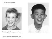 Fragile X Syndrome
