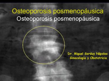 Osteoporosis posmenopusica