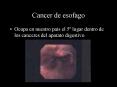 Cancer de esofago PowerPoint PPT Presentation