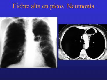 Fiebre alta en picos' Neumona