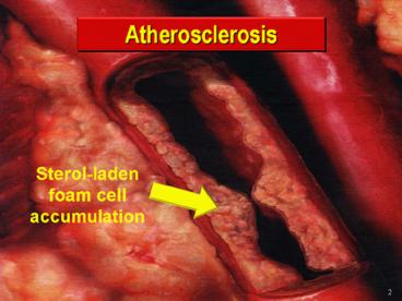 Arterial Plaque and