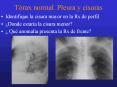 Trax normal' Pleura y cisuras PowerPoint PPT Presentation