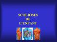 SCOLIOSES DE LENFANT PowerPoint PPT Presentation
