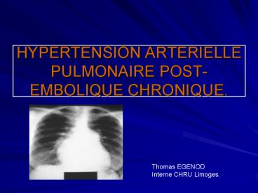 HYPERTENSION ARTERIELLE PULMONAIRE POST-EMBOLIQUE CHRONIQUE.