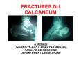 FRACTURES DU CALCANEUM PowerPoint PPT Presentation